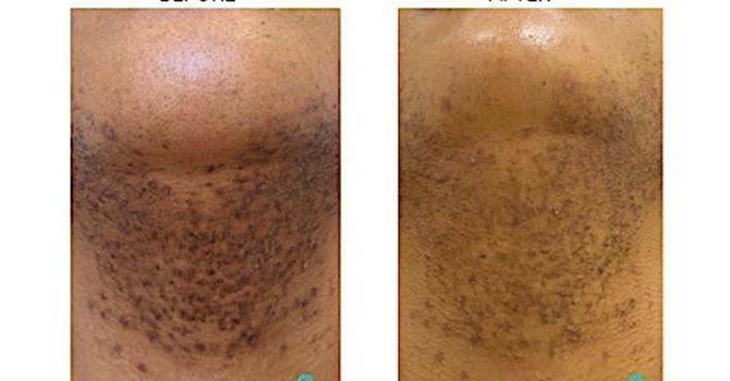 NEW Laser Hair Removal