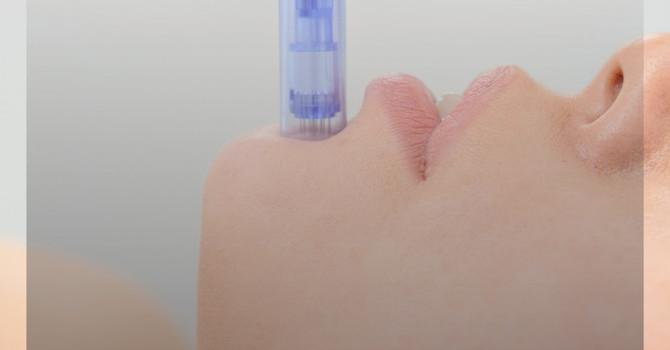 Microneedling 