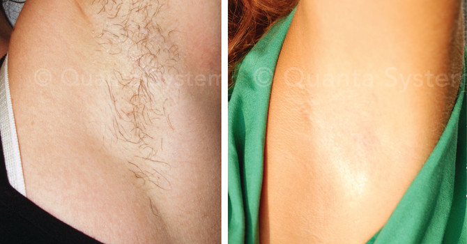 Laser Hair Removal
